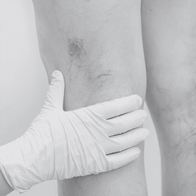 Vein Clarity Package (Large Area) at Kietre Wellness & Aesthetics in North Las Vegas, NV